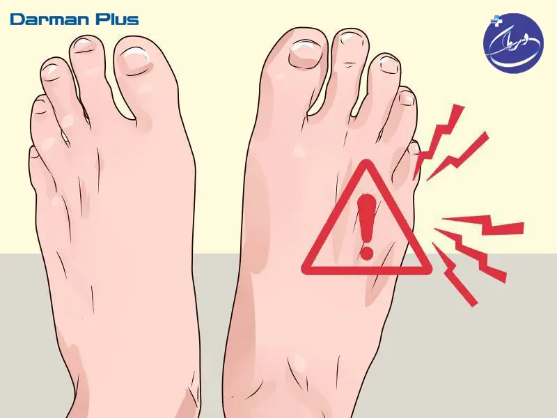 زخم پای دیابتی عفونی 2 درمان پلاس کرج – زخم پای دیابتی عفونی زخم پای دیابتی عفونی