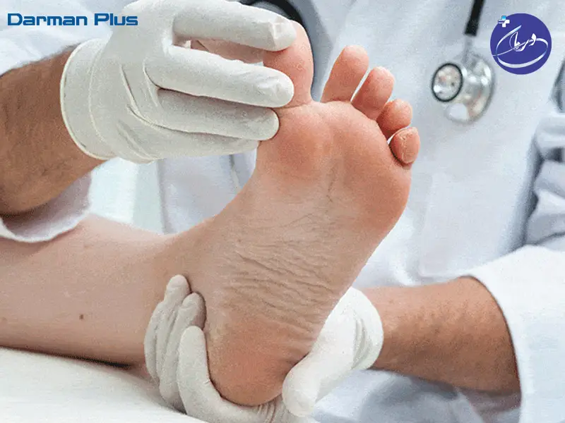 زخم پای دیابتی عفونی 3 درمان پلاس کرج – زخم پای دیابتی عفونی زخم پای دیابتی عفونی