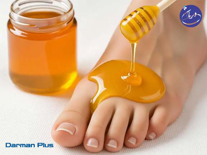 زخم پای دیابتی عفونی 5 درمان پلاس کرج – زخم پای دیابتی عفونی زخم پای دیابتی عفونی